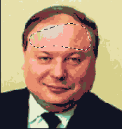Удаление волос